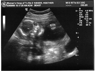 ultrasound picture
