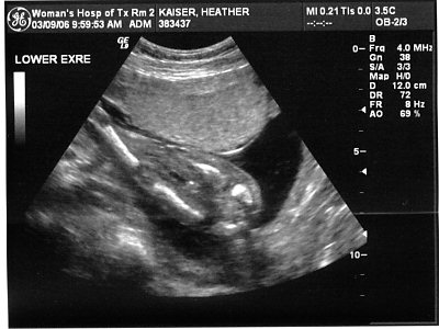ultrasound picture
