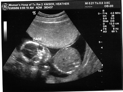 ultrasound picture